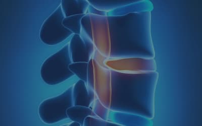 Herniated Disc: It's Not One Wrong Move, It's What You Do Every Day