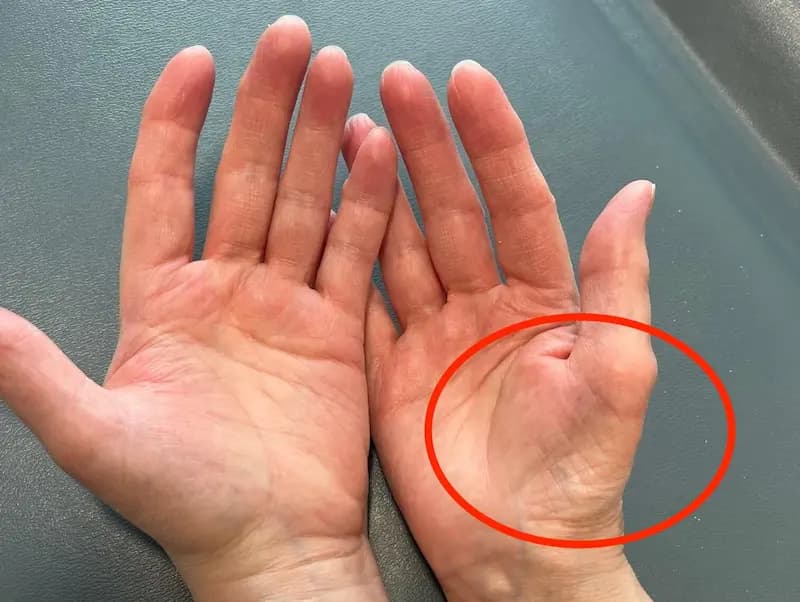 Carpal Tunnel Syndrome