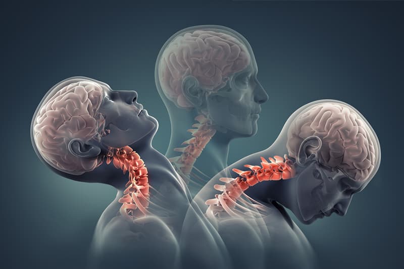 Facet Syndrome