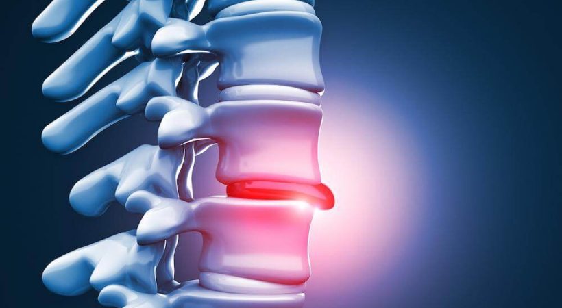 Disc Herniation