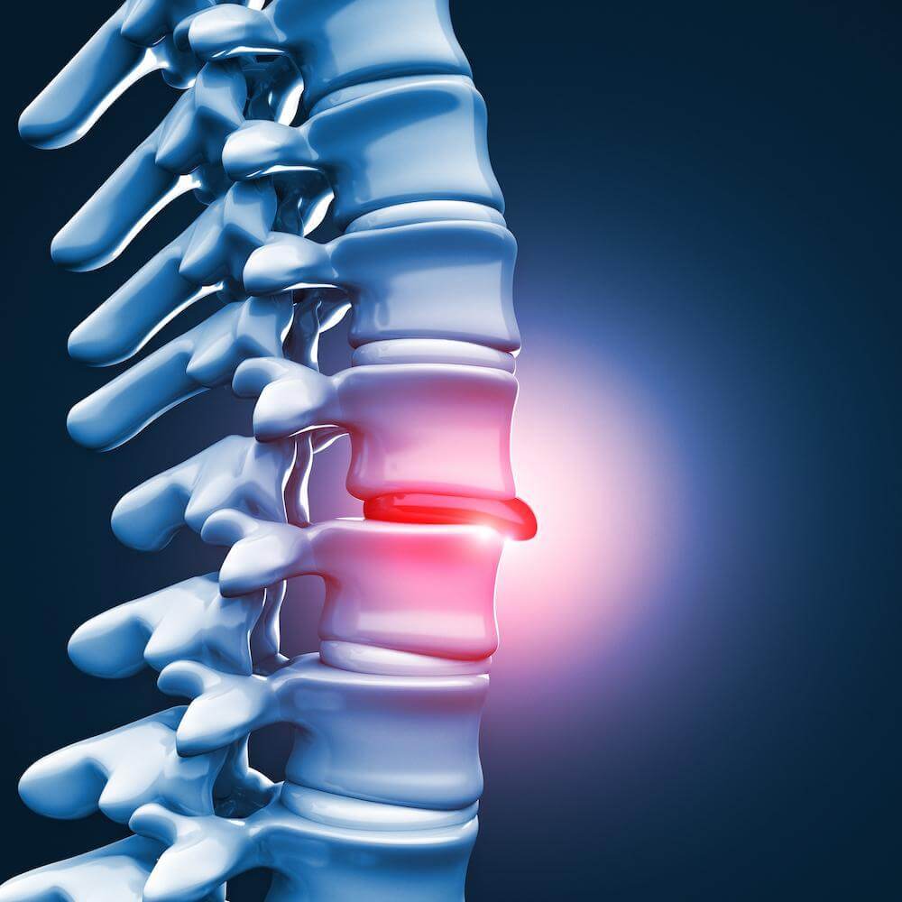 disc-herniation Disc Herniation