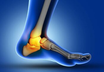 Plantar Fasciitis