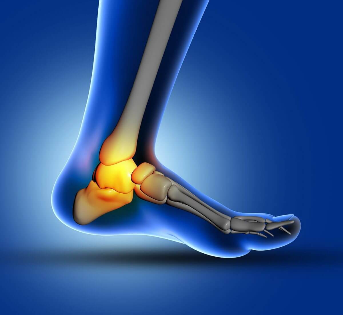 plantar-fascitis Plantar Fasciitis