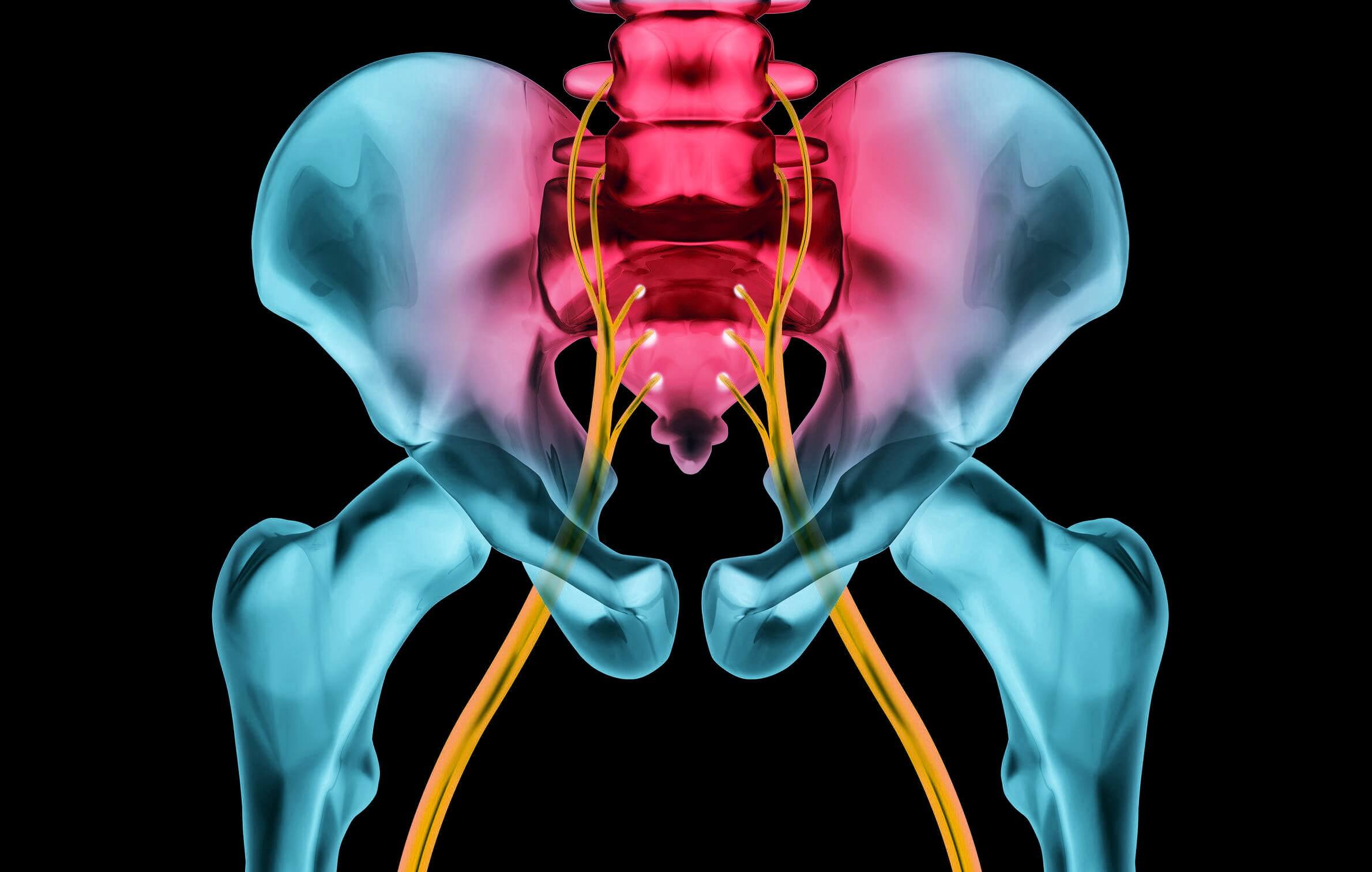 sciatica Sciatica