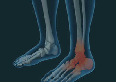 Ankle and Foot Pain