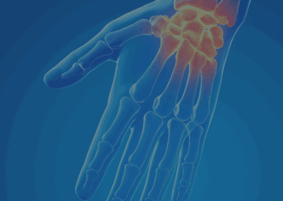 Carpal Tunnel Syndrome