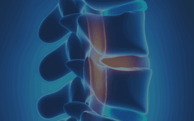 Herniated Disc: It’s Not One Wrong Move, It’s What You Do Every Day