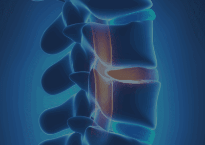 Disc Herniation