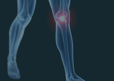 Meniscal Injuries