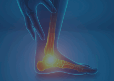 Plantar Fasciitis