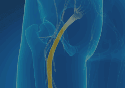 Sciatica Pain Relief