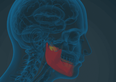 Temporomandibular Joint (TMJ) Dysfunction